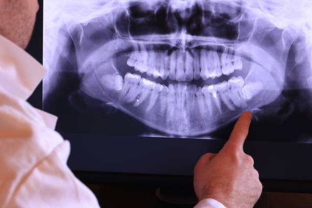 Best Emergency Wisdom Teeth Removal in Elmsford, NY